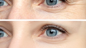 before and after on a good candidate for BOTOX