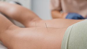 dry needling on a patient’s back of the leg