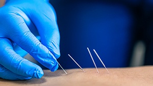 several dry needles in a patient’s back