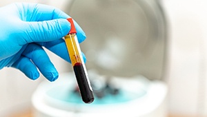 blood vial with platelet-rich plasma